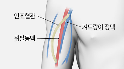 투석혈관 오래 쓰기 유방질환