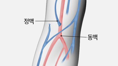 투석혈관 오래 쓰기 유방질환