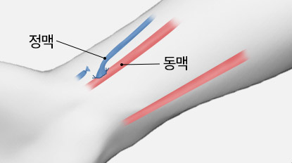 투석혈관 오래 쓰기 유방질환