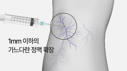 하지정맥류 시술 갑상선질환
