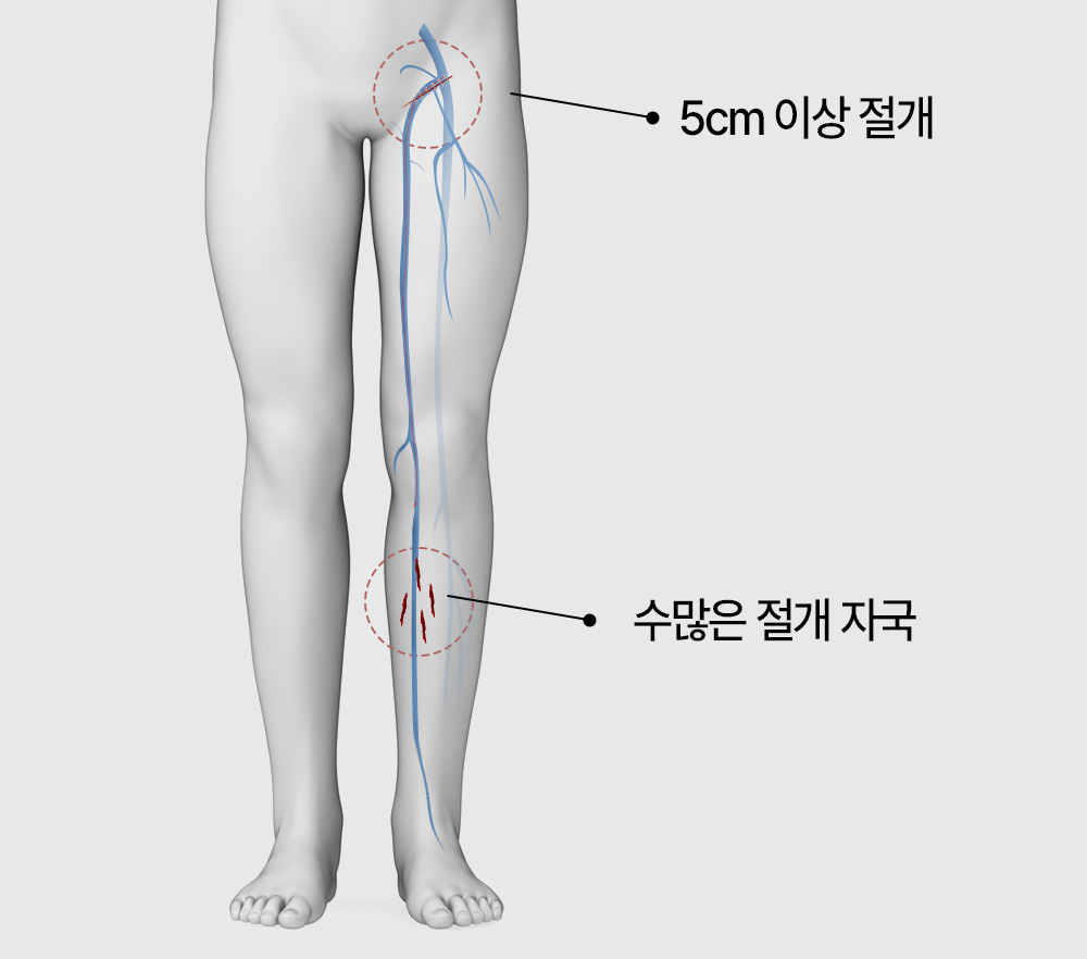 하지정맥류 시술 갑상선질환