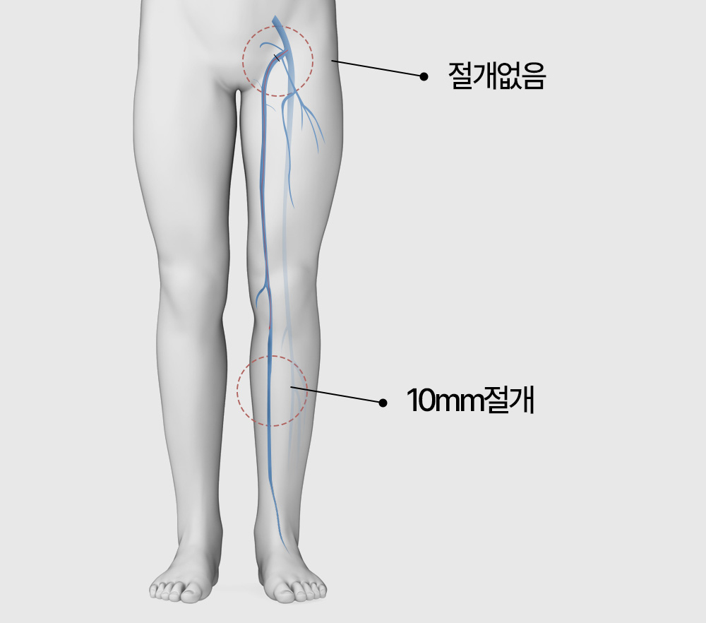 하지정맥류 시술 갑상선질환