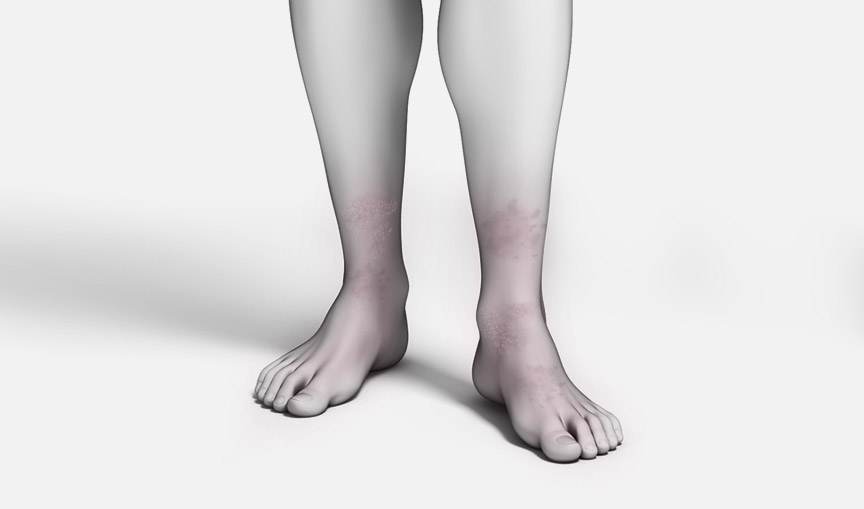하지정맥류 시술 갑상선질환
